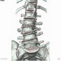 腰椎３Ｄ画像