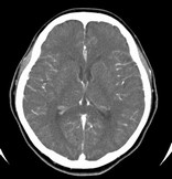 頭部造影ＣＴ画像